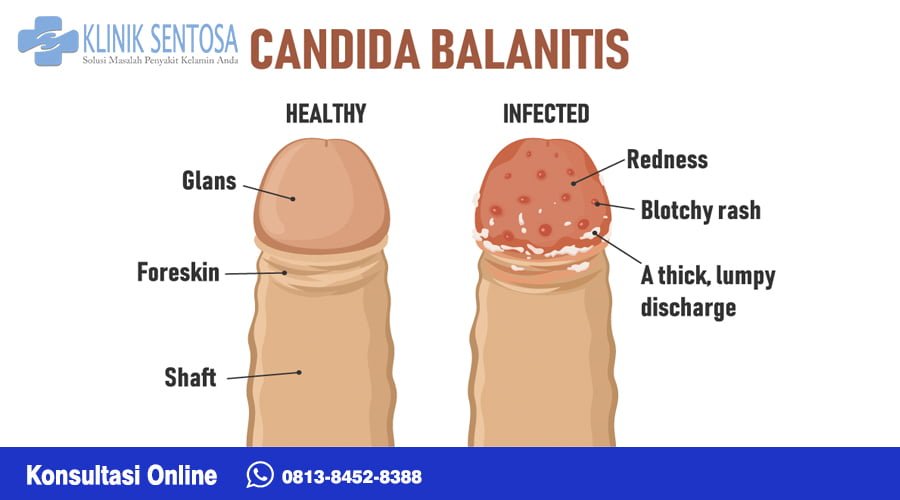 Balanitis merupakan pembengkakan akibat iritasi pada kulit dan kepala penis. Kondisi ini juga dikenal sebagai radang kepala penis. Penyakit ini bisa menimbulkan gejala, seperti penis nyeri, kemerahan, bengkak, bau tak sedap, dan nyeri saat buang air kecil.